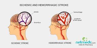 Identifying a stroke early is the key to the most effective treatment. Stroke Cerebrovascular Accident Causes Symptoms And Treatment
