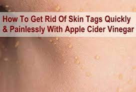 How To Remove Skin Tags With Apple Cider Vinegar Skin Tag Removal Skin Tags Apple Cider Vinegar Skin Tag