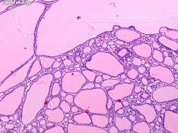 Image result for Multinodular Goiter