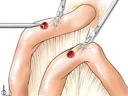 Image result for Enterostomy