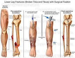 Posted on april 18, 2019april 18, 2019. Broken Leg Diagram Diagram Design Sources Series Toast Series Toast Paoloemartina It