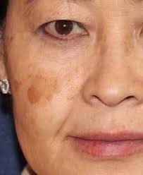 PicoWay Laser Treatments in Grand Cayman » BodyBarn Medi Spa