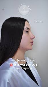 ✨️3° ᴾᵃʳᵗᵉ✨️ ᴾᵉʳᶠⁱˡᵃᵐⁱᵉⁿᵗᵒ ᶠᵃᶜⁱᵃˡ ʸ ᴬᵘᵐᵉⁿᵗᵒ ᵈᵉ ᴸᵃᵇⁱᵒˢ, ¡Resalta tu belleza  natural con el perfilamiento facial utilizando @divineusacidohialuronico,  aplicado por el reconocido y experimentado Dr. ...