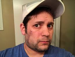 This stick will only be available at pure hockey stores and online. Christmas Selfie With A Brand New Scar Album On Imgur