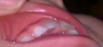 Follow Up Post Two Front Grey Teeth In Three Year Old Peoples Experiences