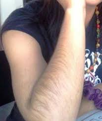 This short, transitional phase only lasts two to three. Indian Women And Laser Induced Hair Growth Follikill Electrolysis