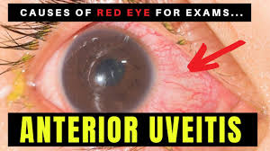 Image result for Uveitis