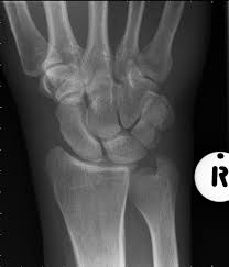 Image result for Pisiform Bone