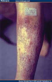 Image result for Lichen Simplex Chronicus