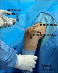 Image result for Elbow Joint Injection