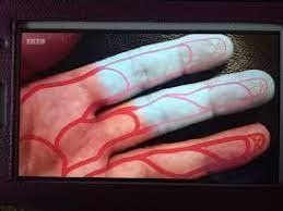 Comment prononcer 'disease' en anglais britannique. How To Say Raynaud S Disease How To Pronounce Raynaud S Disease Lovely Hands