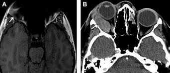MR Imaging Artifacts in the Head and Neck Region