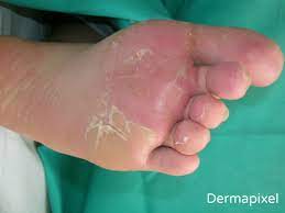 Dermapixel Al Nino Se Le Pelan Los Pies