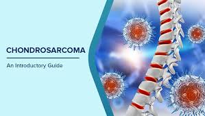 Image result for Chondrosarcoma