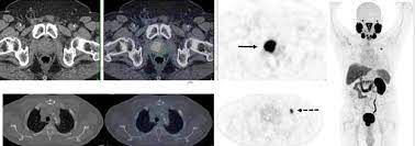 Other symptoms of recurrent cancer may depend on whether and where the cancer has spread. Psma Pet Ct Can Change Management In Recurrent Prostate Cancer Imaging Technology News