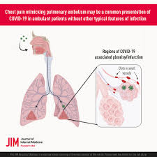 Yeh un dinon ki baat hai (transl. Chest Pain Mimicking Pulmonary Embolism May Be A Common Presentation Of Covid 19 In Ambulant Patients Without Other Typical Features Of Infection Harrison Journal Of Internal Medicine Wiley Online Library