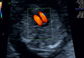 Ziel dieser untersuchung ist die darstellung und beurteilung der funktion kindlicher organe, der fruchtwassermenge sowie die beurteilung des kindlichen wachstums. Ersttrimester Ultraschall Fruhe Feindiagnostik Nackenfaltenmessung Praxis Fur Pranatale Diagnostik