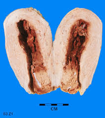 Image result for Retained Placenta