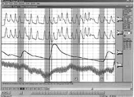 typical polygraph chart the two top lines are the breathing