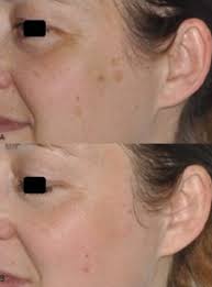 Image result for Solar Lentigo