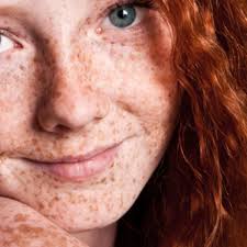 Image result for Freckled skin