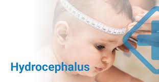 Image result for Hydrocephalus
