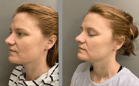 Laser Skin Rejuvenation