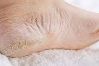 Calo Seco No Dedo Do Pé Como Tirar Calo Seco Do Pe Com Aspirina Cuidados Com O Corpo Pes Rachados Cuidado Com Os Pes