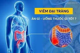Nhiều người lo lắng khi mắc viêm đại tràng cần phải ăn uống kiêng khem rất cẩn thận, không dám ăn gì đôi khi chỉ. Viem Ä'áº¡i Trang La Gi Nguyen Nhan Triá»‡u Chá»©ng Cach Ä'iá»u Trá»‹