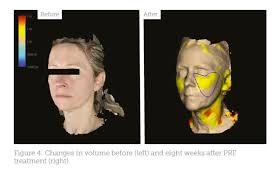 Pulse repetition frequency (prf) of the radar system is the number of pulses that are transmitted per second. Volumising The Face Using Prf Aesthetics