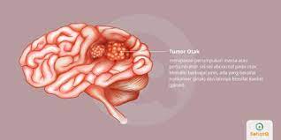 Hal ini bisa membuat penglihatan kita kabur, kehilangan penglihatan, atau mengalami penglihatan. Tumor Otak Tanda Dan Gejala Penyebab Cara Mengobati Cara Mencegah