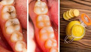 Cavities should be treated by a dentist to ensure no complications occur. How To Fix A Cavity Naturally Teethwalls