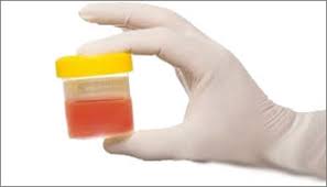 However, some underlying causes are associated with the additional symptoms that. Blood In The Urine Haematuria The British Association Of Urological Surgeons Limited