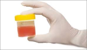 Finding blood in your urine can be a stressful experience. Blood In The Urine Haematuria The British Association Of Urological Surgeons Limited