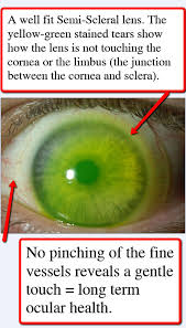 On the negative, it takes a lot of time to reshape it as well. Scleral Lenses Wilcox Eye Center