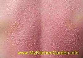 Maybe you would like to learn more about one of these? Natural Remedies For Sunburns