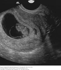 Image result for First Trimester Ultrasound