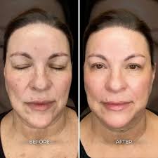 Albuquerque Laser Treatment Before & After Gallery: Chrome Aesthetics