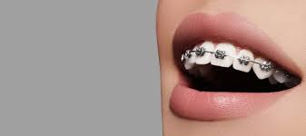 Common causes for tooth ache and dental abscess, their prevention and when you may need to see an emergency. How To Whiten Teeth With Braces In Canada South Surrey Smiles