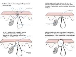 Learn how to get rid of milia with these expert removal tips from a dermatologist. Those Pesky Little White Spots Tackling Milia Lola Maja