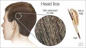 Image result for lice vs nits