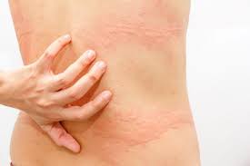 Often, the cause of chronic hives is not clear. How To Soothe Hives U S Dermatology Partners Blog Blog