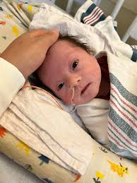 Can babies with Down syndrome breastfeed?