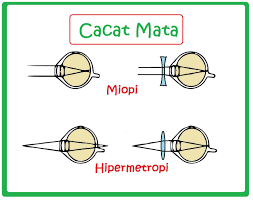 Check spelling or type a new query. Lensa Mata Memiliki Kemampuan Untuk Menebal Dan Memipih Apabila Lensa Mata Tidak Dapat Memipih Brainly Co Id
