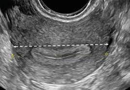 Identify indications for pelvic ultrasound evaluation. Ultrasound Female Pelvic Anatomy Obgyn Key