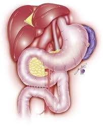 Favorable Minimal Invasive Surgery In The Treatment Of Superior Mesenteric Artery Syndrome Case Report Sciencedirect
