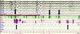 Image result for REM Sleep Behavior Disorder