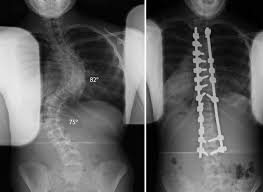 how does a surgeon fix scoliosis new
