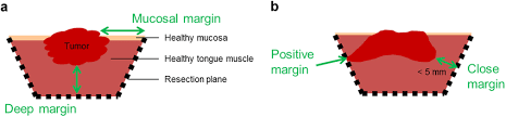 The complexity of the excision depends on the tumor type, size, and location. A Cross Section Of A Tongue Tumor Specimen With The Definitions Of Download Scientific Diagram