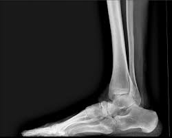 Image result for Clubfoot